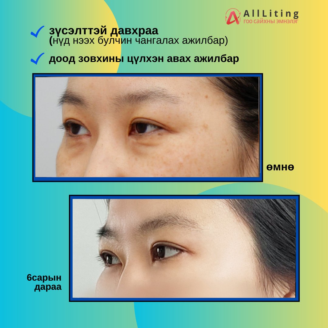 #ҮЙЛЧЛҮҮЛЭГЧИЙН_БОДИТ_ҮР_ДҮН #цүлхэн
хийлгэсэн ажилбар
📷зүсэлттэй давхраа
(нүд нээх булчин чангалах ажилбар)
📷доод зовхины цүлхэн авах ажилбар

📷📷 ҮЗЛЭГ/ЗӨВЛӨГӨӨ үнэгүй хийж зөвхөн таньд тохирсон мэс заслын төлөвлөгөөг гаргана.
📷монгол ажилтан: 010-4931-4451
