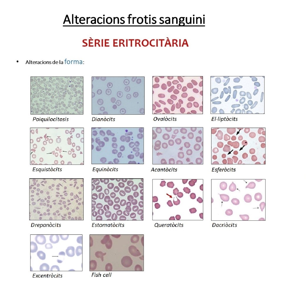 CatlabAIE's tweet photo. A l’hora de revisar el frotis sanguini al microscopi, és molt important revisar també la sèrie vermella. Presentem un recull d’imatges de diferents alteracions q podem trobar als eritròcits en la seva forma, mida, color o inclusions. #hematologia #eritrocitos #hematies #serieroja https://t.co/YKyjH0ytvX