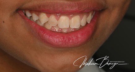 التشخيص السليم والالتزام بالتعليمات دائما تؤدي إلى نتائج جميلة

مريضة (١١ سنة) تعاني من بروز الاسنان وقيل لها علاجك قد يكون عملية جراحية مستقبلا...
تم علاجها بالقوالب الشفافة و بدون الحاجة للخلع ولا العملية 👍