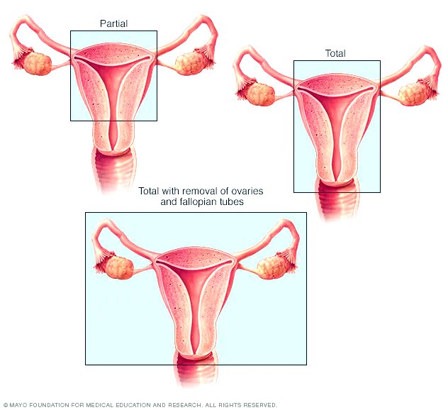 Omar M Ghanem (@omghanemmd) on Twitter photo 🚩 Women w BMI >40 requiring nonurgent hysterectomy may benefit from #BariatricSurgery first
🔺 NIS database
🔺 Matched analysis
🔺 Women w bari hx had ⬇️ complications & ⬇️ length of stay
🔝publication led by @maia_in_med in prestigious <a href="/SurgJournal/">SURGERY Journal</a>
surgjournal.com/article/S0039-… 🚩 Women w BMI >40 requiring nonurgent hysterectomy may benefit from #BariatricSurgery first
🔺 NIS database
🔺 Matched analysis
🔺 Women w bari hx had ⬇️ complications & ⬇️ length of stay
🔝publication led by @maia_in_med in prestigious <a href="/SurgJournal/">SURGERY Journal</a>
surgjournal.com/article/S0039-…