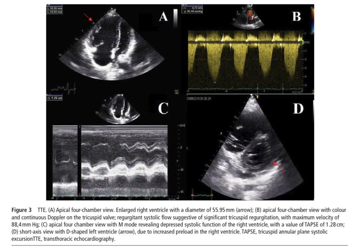 Ed_Alania's tweet photo. 🔵 Comprehensive imaging in patients with suspected pulmonary arterial hypertension @Heart_BMJ #CardioEd #Cardiology #Cardiotwitter #echofirst https://t.co/reReJ4ByIb