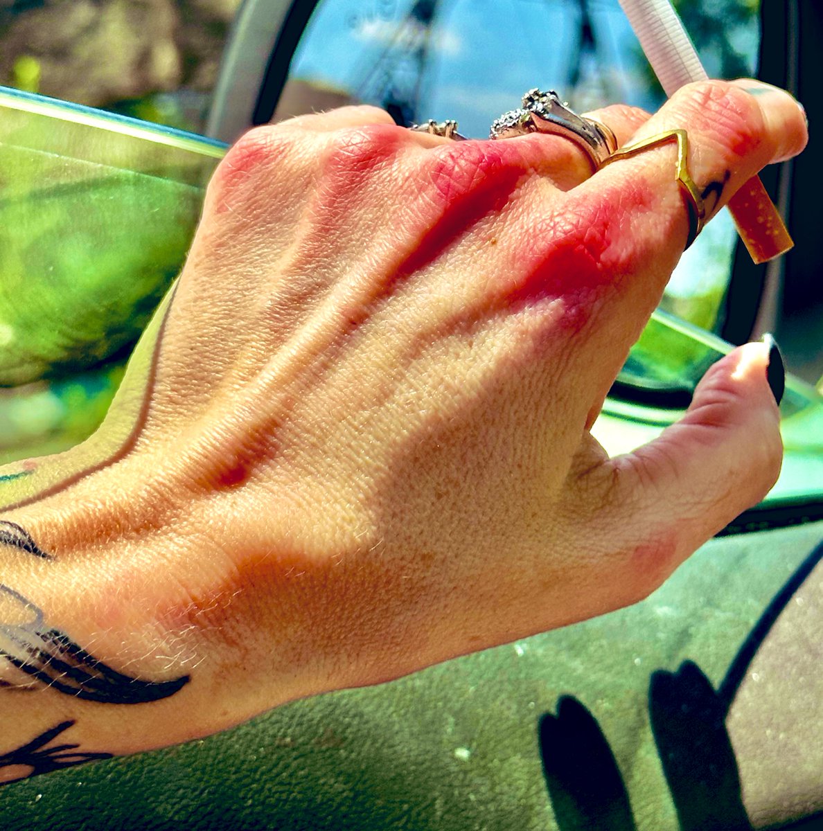 That time you swore you were having an allergic reaction on your knuckles then remembered you were a smoker during a heatwave.