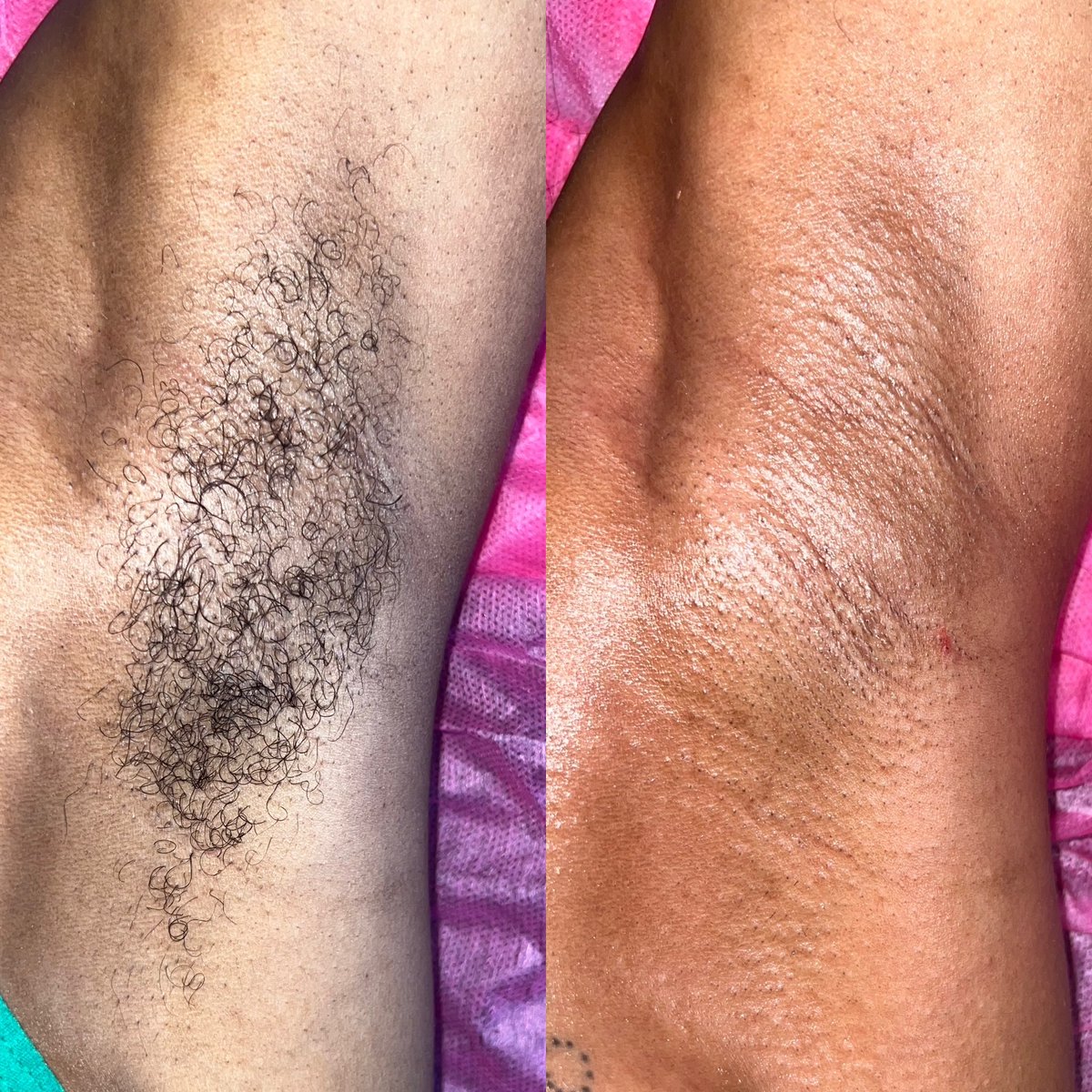 BeautifiedbyJas's tweet photo. Ready to Get your Under Arms Waxed ? 💕

TEXT 510 838 5344😌 https://t.co/QfGDS48q7Z