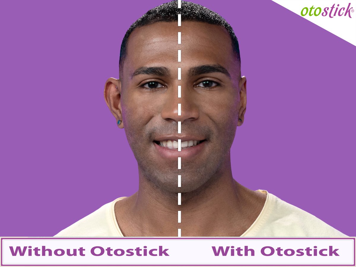 Otostick cosmetic ear corrector can be used by both men and women! 👂
Easy to use and provides instant results.😉

Check out our website at:
otostick.com

#Otostick #man #woman #corrector #cosmetic #ears #him #her #discreet #earcorrector #protrudingears #prominentears