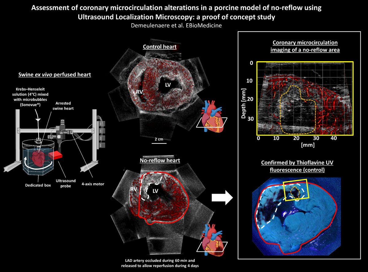 Clement Papadacci (@cpapadacci) on Twitter photo Our new publication on coronary microcirculation has just been published in <a href="/eBioMedicine/">eBioMedicine – The Lancet Discovery Science</a>! Find Open access here: thelancet.com/journals/ebiom…
Credits to <a href="/PhysMedParis/">Physics for Medicine Paris</a> <a href="/Inserm/">Inserm</a> <a href="/ESPCI_Paris/">ESPCI Paris - PSL</a>. Work supported by ANR and <a href="/NVIDIAHealth/">NVIDIA Healthcare</a> Our new publication on coronary microcirculation has just been published in <a href="/eBioMedicine/">eBioMedicine – The Lancet Discovery Science</a>! Find Open access here: thelancet.com/journals/ebiom…
Credits to <a href="/PhysMedParis/">Physics for Medicine Paris</a> <a href="/Inserm/">Inserm</a> <a href="/ESPCI_Paris/">ESPCI Paris - PSL</a>. Work supported by ANR and <a href="/NVIDIAHealth/">NVIDIA Healthcare</a>