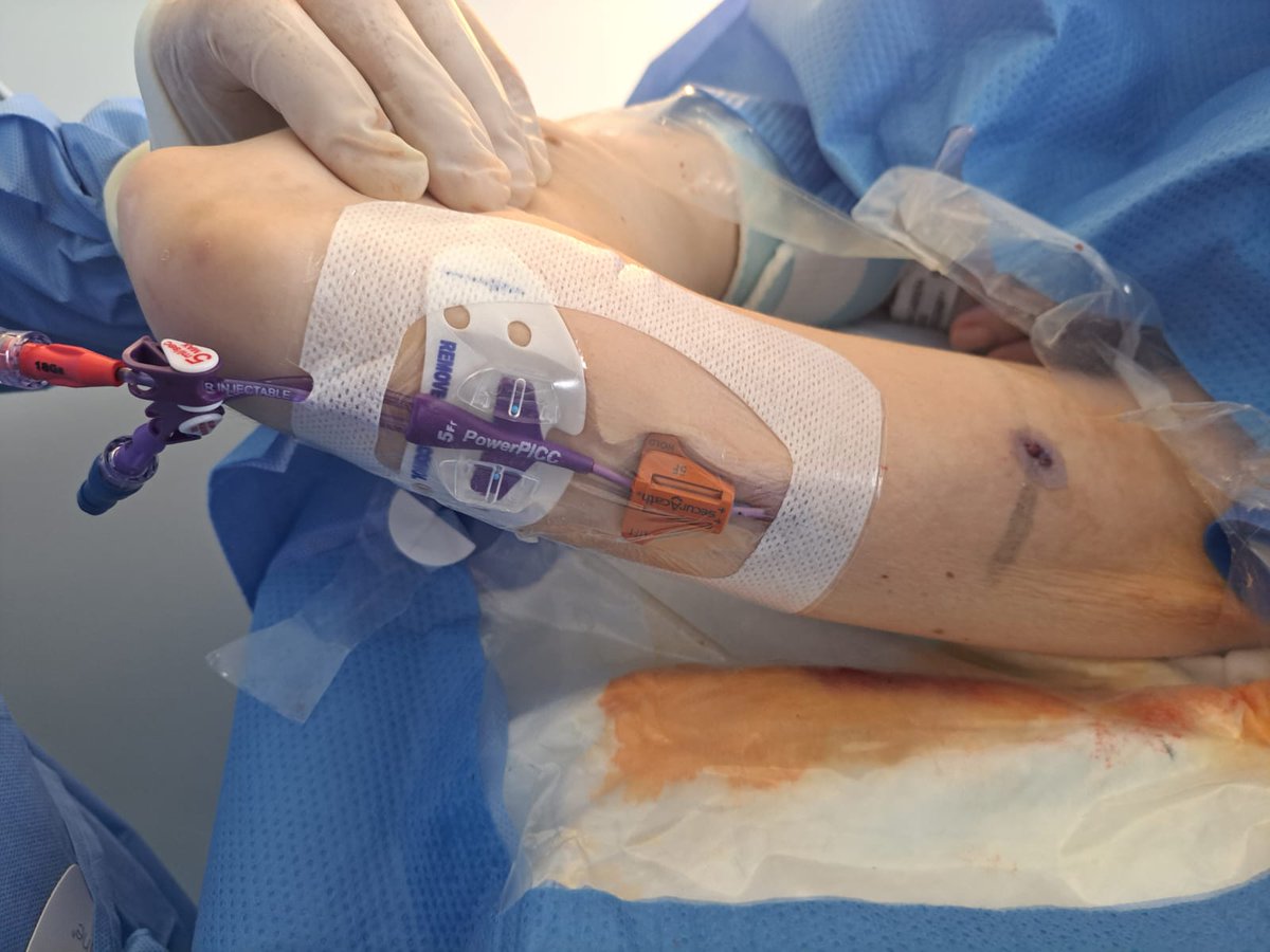 SantiVecinoV's tweet photo. PICC en paciente con deterioro cognitivo y arrancamiento de múltiples dispositivos , se realiza tunelización clasica a región tricipital para dificultar acceso con la mano contralateral. En este caso se combina con pseudotunel para calibre adecuado. https://t.co/CvI704MLl9