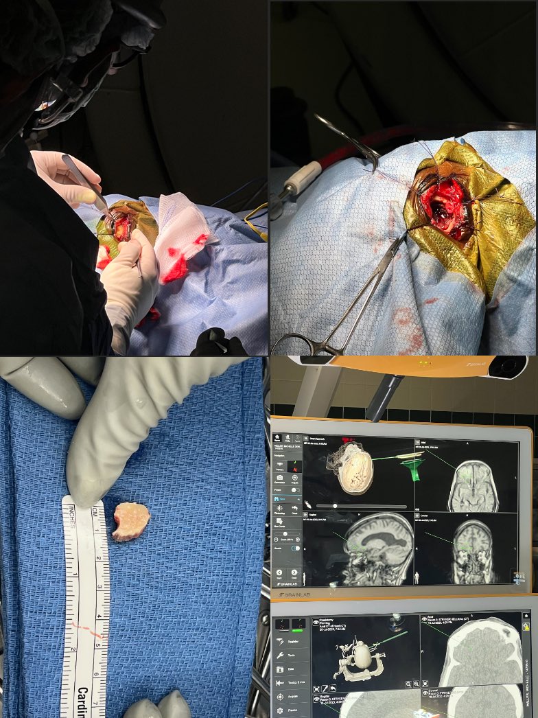 Rizwan Tahir (@riztahirmd) on Twitter photo Eyebrow, Supraorbital Craniotomy. Never did one in residency or 2 fellowships but learned by studying and from colleagues. Possibly my new favorite approach. <a href="/MedStarWHC/">MedStar Washington</a> <a href="/MGUHNeurosurg/">Georgetown/WHC Neurosurgery</a> #neuroscience #selfdevelopment #MedEd Eyebrow, Supraorbital Craniotomy. Never did one in residency or 2 fellowships but learned by studying and from colleagues. Possibly my new favorite approach. <a href="/MedStarWHC/">MedStar Washington</a> <a href="/MGUHNeurosurg/">Georgetown/WHC Neurosurgery</a> #neuroscience #selfdevelopment #MedEd