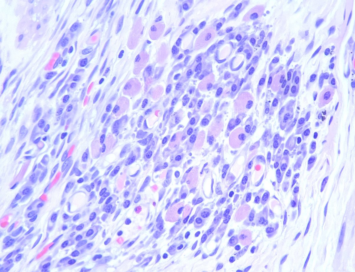 This is a group of plasma cells. Some of them contain Russell bodies, which are cytoplasmic inclusions containing immunoglobulins. We often associate these with Russell body gastritis, but this is in an ileostomy in a patient with Crohn’s #gipath <a href="/ZuckerPathRes/">Zucker Pathology Residency</a>