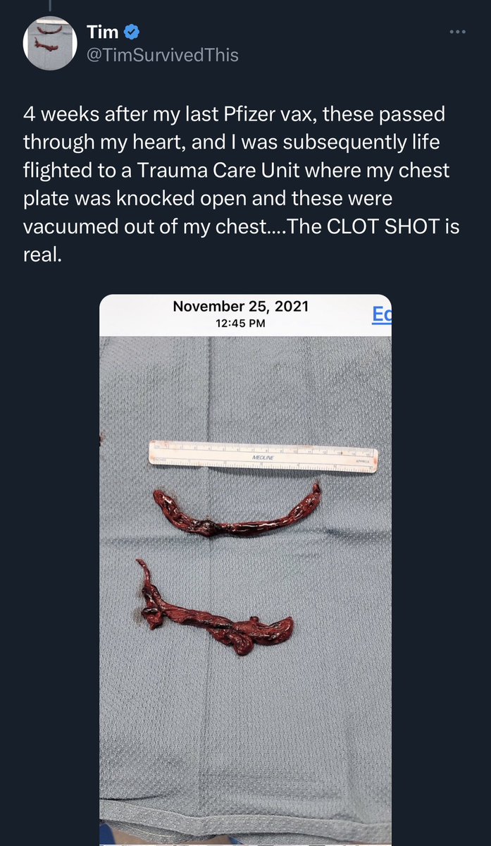 DiedSuddenly_'s tweet image. After the release of the Died Suddenly film, the Media relentlessly slandered us as “misinformation agents” for months. 

Not a single outlet could debunk the vax-induced fibrous clot findings. 

The embalmer’s findings are real. 

The sudden deaths are real. 

The fibrous clots…