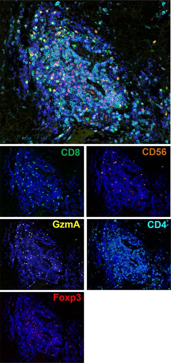 Akoya Biosciences (@akoyabio) on Twitter photo Researchers using our #PhenoImager solution for #multiplexed #immunohistofluorescence revealed that #tertiarylymphoidstructures presence in advanced soft-tissue #sarcomas is a potential predictive #biomarker. go.nature.com/3akn3TY
#sarcomaawarenessmonth <a href="/NatureMedicine/">Nature Medicine</a> Researchers using our #PhenoImager solution for #multiplexed #immunohistofluorescence revealed that #tertiarylymphoidstructures presence in advanced soft-tissue #sarcomas is a potential predictive #biomarker. go.nature.com/3akn3TY
#sarcomaawarenessmonth <a href="/NatureMedicine/">Nature Medicine</a>