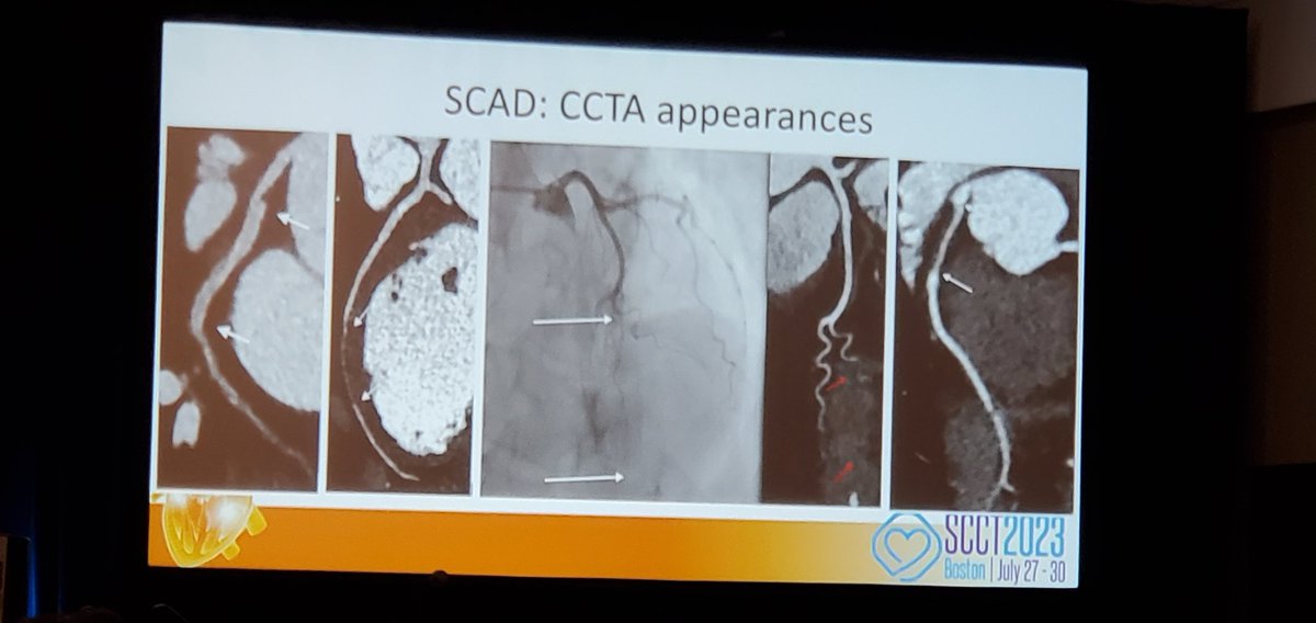 Noninvasive imaging in SCAD - we are nearly there! Great insights from Dr Dave Adlam #SCCT2023 #yescct @Heart_SCCT