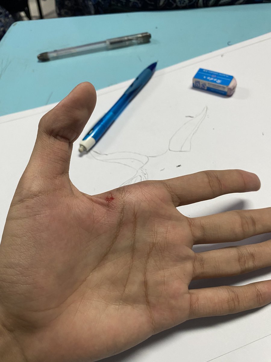 Kriskelll's tweet photo. biasanya kalo luka gini lapor ke dia 😩 https://t.co/odWdCwHWMm