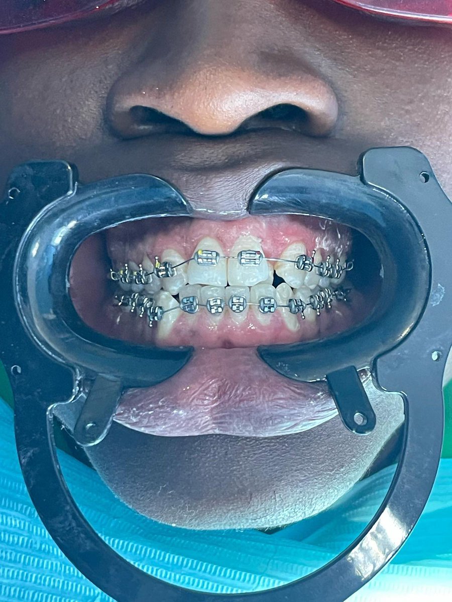 dcijuja's tweet photo. I recommend kama meno inakusumbua fika Kwa @Branicemercy Give this doc All your Tooth Money bana Experience ako nayo ya Kutosha bana 🔥🔥Ako located  Along Kiambu Road at Feruzi Towers 3rd floor wing A opposite Quickmart . https://t.co/J6sSrgUUFw