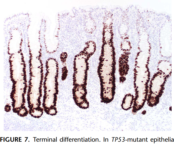 Appl Immunohistochem Mol Morphol Journal (@aimmjournal) on Twitter photo p53 as Exemplar Next-generation #IHC Marker, Pan-cancer application
Online now! Time to dig in #pathtwitter... Another comprehensive review by <a href="/IHC_guy/">Andrew Bellizzi 🇺🇦</a>, full of #wallhangers and practical applications
journals.lww.com/appliedimmunoh…
Accompanying <a href="/ISIMMweb/">ISIMM Web</a>-inar:
isimm.org/education/isim… p53 as Exemplar Next-generation #IHC Marker, Pan-cancer application
Online now! Time to dig in #pathtwitter... Another comprehensive review by <a href="/IHC_guy/">Andrew Bellizzi 🇺🇦</a>, full of #wallhangers and practical applications
journals.lww.com/appliedimmunoh…
Accompanying <a href="/ISIMMweb/">ISIMM Web</a>-inar:
isimm.org/education/isim…