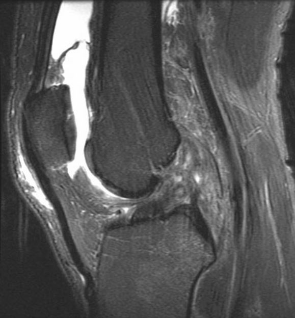 #CaseOfTheWeek🎉

📢✅Answer for Case #30: #Sign🟰Segond fracture &amp; #Diagnosis🟰Torn ACL🦴🦵

Stay tuned for next week's Case #31 and have a great weekend!!🥳🎉

#FOAMrad #RadEd #OrthoTwitter <a href="/ssr_rwg/">SSR_RWG</a> @UWRadRes #MedEd #OrthoSports @AOSSM_SportsMed