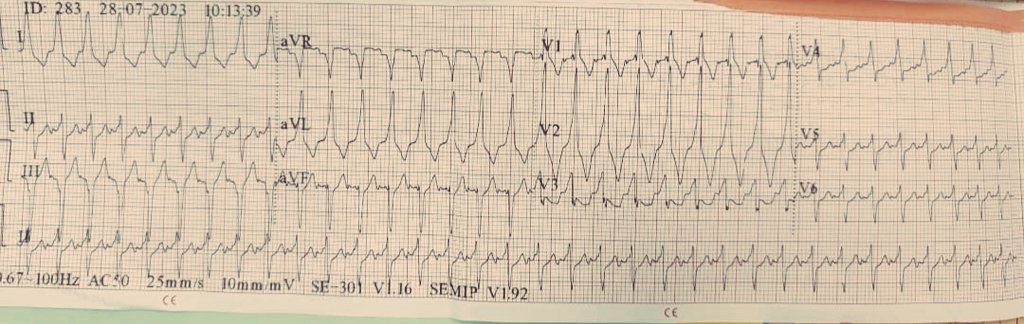 DrRazi4's tweet photo. A 60+y.o lady with DM and HTN admitted for post surgical abdominal sepsis. ECG 1 and 2- SVT with aberrancy or VT?@BrooksWalsh @EM_RESUS @adribaran @SchakrabartiEP @ECGfan @DrRajeshG1 @ECGEPSCADEVICE @ecgrhythms @HakimIcu @Hapa_EP @Jagdish26039718 @The_Nanashi_O https://t.co/TgL0baRPBA