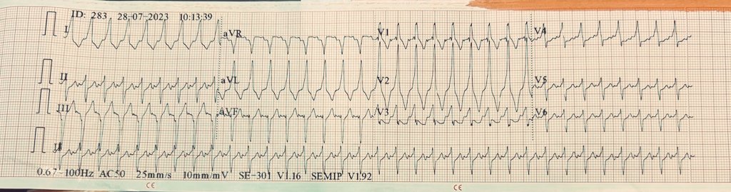DrRazi4's tweet photo. A 60+y.o lady with DM and HTN admitted for post surgical abdominal sepsis. ECG 1 and 2- SVT with aberrancy or VT?@BrooksWalsh @EM_RESUS @adribaran @SchakrabartiEP @ECGfan @DrRajeshG1 @ECGEPSCADEVICE @ecgrhythms @HakimIcu @Hapa_EP @Jagdish26039718 @The_Nanashi_O https://t.co/TgL0baRPBA