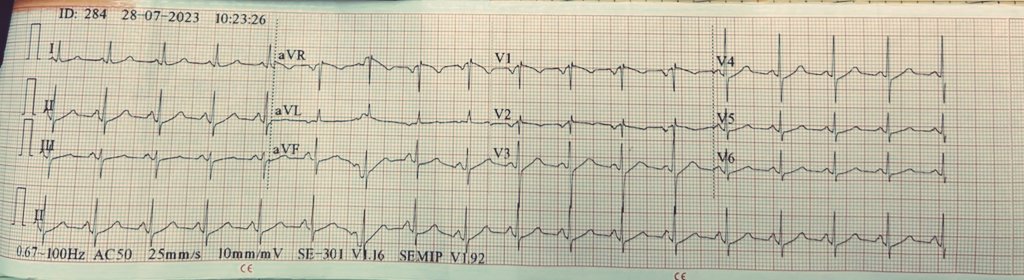 DrRazi4's tweet photo. A 60+y.o lady with DM and HTN admitted for post surgical abdominal sepsis. ECG 1 and 2- SVT with aberrancy or VT?@BrooksWalsh @EM_RESUS @adribaran @SchakrabartiEP @ECGfan @DrRajeshG1 @ECGEPSCADEVICE @ecgrhythms @HakimIcu @Hapa_EP @Jagdish26039718 @The_Nanashi_O https://t.co/TgL0baRPBA