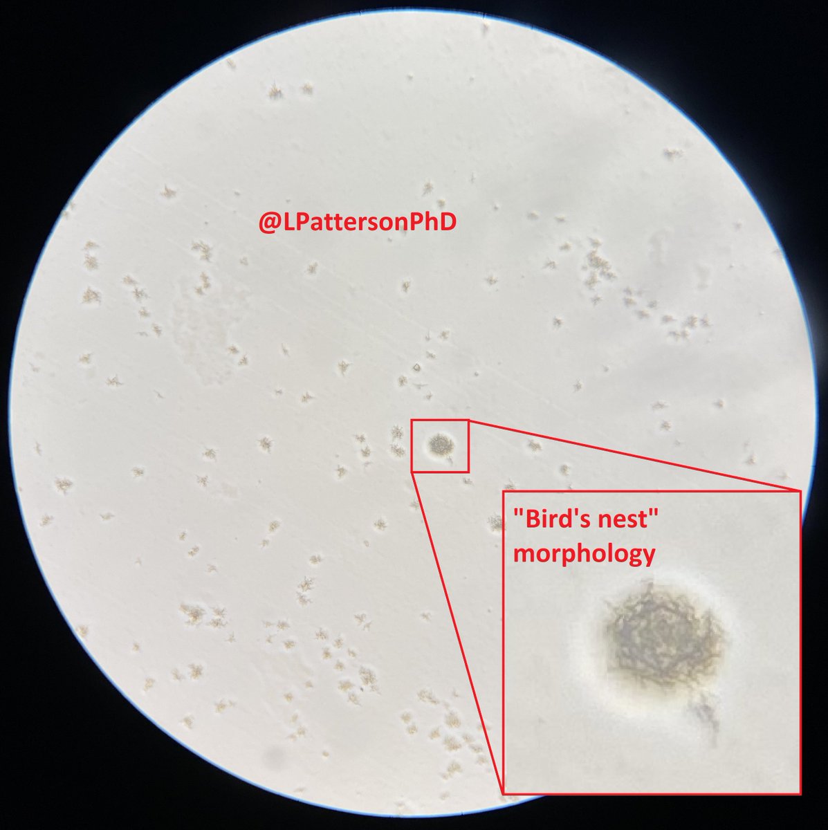 LPattersonPhD's tweet photo. Patient presents w/ shortness of breath, cough, and night sweats. Prev undiagnosed HIV (viral load >500k)

-AFB culture shows organisms with "bird's nest" morphology
-Preferentially grows @ 40-45C
-TB-like presentation &amp; disease
-Assoc. w/ hot water systems

=Mycobacterium xenopi https://t.co/vXBtRtwzqc