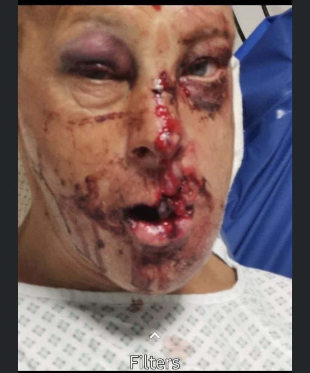 Hit and run in clydach knocked of his bicycle and left for dead how could someone do this #arsehole cctv will be your downfall keep looking over your shoulder