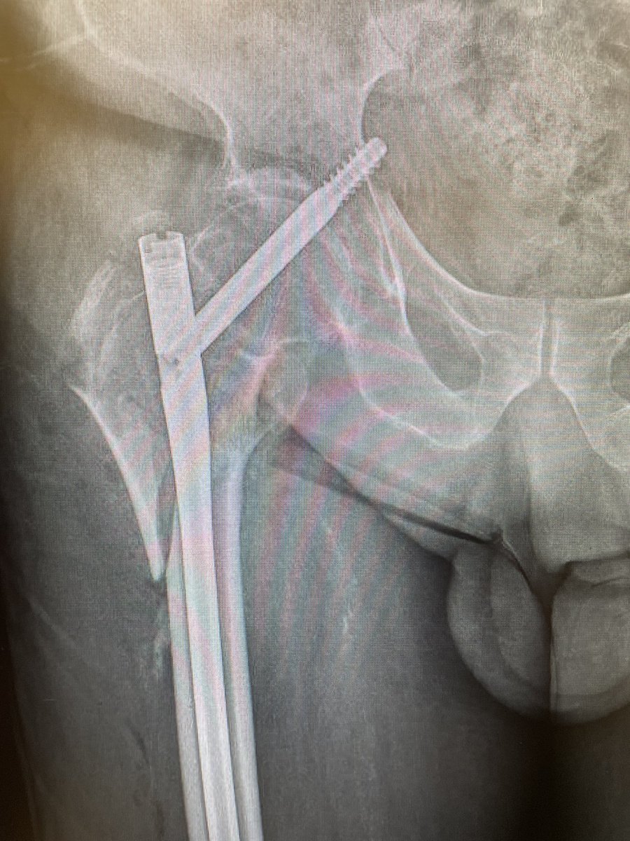 when you open you mailbox at work after 3 weeks holiday… 

A quick literature search with <a href="/traumaticum/">Dr. Edward Oates</a> ‘s AI engine makes it appear a rare complication, but we have seen quite a few of these in the past three years after introduction of Gamma-3.. and yes: set screw was tightened