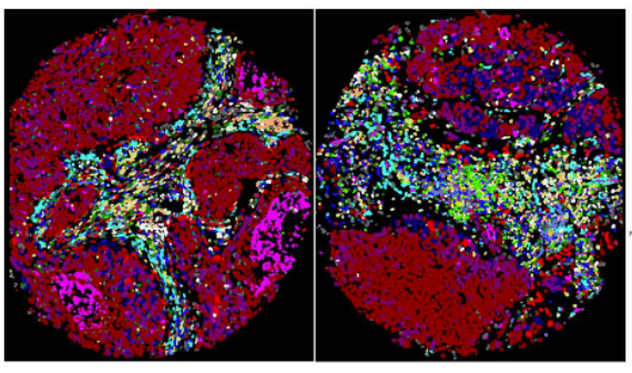 Arutha K (@aruthak) on Twitter photo From Pixels to Insights: Unveiling Spatial Immune Associations of Immunotherapy Response in Non-Small Cell Lung Cancer using Multiplexed Tissue Imaging researchsquare.com/article/rs-304… <a href="/CanTooRunSwim/">Can Too</a> <a href="/josephyunis/">Dr Yunis (PhD)</a> <a href="/DrRahulLadwa/">Dr Rahul Ladwa</a> <a href="/EnableMedicine/">Enable Medicine</a> @Kaur_Gulpree <a href="/AkoyaBio/">Akoya Biosciences</a> #lungcancer From Pixels to Insights: Unveiling Spatial Immune Associations of Immunotherapy Response in Non-Small Cell Lung Cancer using Multiplexed Tissue Imaging researchsquare.com/article/rs-304… <a href="/CanTooRunSwim/">Can Too</a> <a href="/josephyunis/">Dr Yunis (PhD)</a> <a href="/DrRahulLadwa/">Dr Rahul Ladwa</a> <a href="/EnableMedicine/">Enable Medicine</a> @Kaur_Gulpree <a href="/AkoyaBio/">Akoya Biosciences</a> #lungcancer