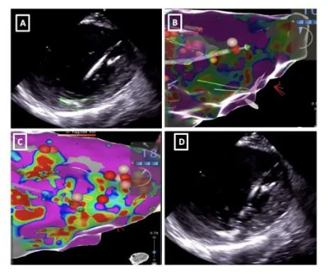 JAFIB&EP (@jafib_ep) on Twitter photo Ultrasound Image Integration for Mapping and Ablation of Ventricular Arrhythmias buff.ly/44iZLoL @adnan_ahmedMD @dj_lakkireddy <a href="/djdardenMD/">Doug Darden</a> <a href="/krishpothineni/">Krishna Pothineni</a> Ultrasound Image Integration for Mapping and Ablation of Ventricular Arrhythmias buff.ly/44iZLoL @adnan_ahmedMD @dj_lakkireddy <a href="/djdardenMD/">Doug Darden</a> <a href="/krishpothineni/">Krishna Pothineni</a>