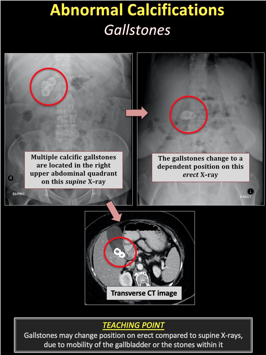 Rad_Bits's tweet photo. Picture worth a thousand words! Teaching point on gallstones on abdominal X-rays with CT correlation #surgery #Medical #medicine #radiology #Radiologist #radres #radcase #FOAMed #FOAMrad #MedEdForum #med101 #med15 #med16 #med17 #med18 #med19 #med20 #uqupharm37 #KSU #KAU #med10 https://t.co/k9BiUkkgpW