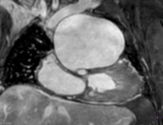 camille4heart's tweet image. Excited to share our experience with #neoaortic #rootreplacement after #Fontan operation 
@AATSJournals 
@CHRI_ResearchNE 
@ChildrensOmaha 
#chd #congenitalheart #singleventricle #heartmatters 

jtcvstechniques.org/article/S2666-…