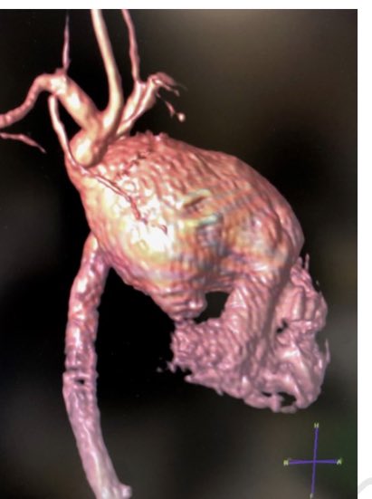 camille4heart's tweet image. Excited to share our experience with #neoaortic #rootreplacement after #Fontan operation 
@AATSJournals 
@CHRI_ResearchNE 
@ChildrensOmaha 
#chd #congenitalheart #singleventricle #heartmatters 

jtcvstechniques.org/article/S2666-…