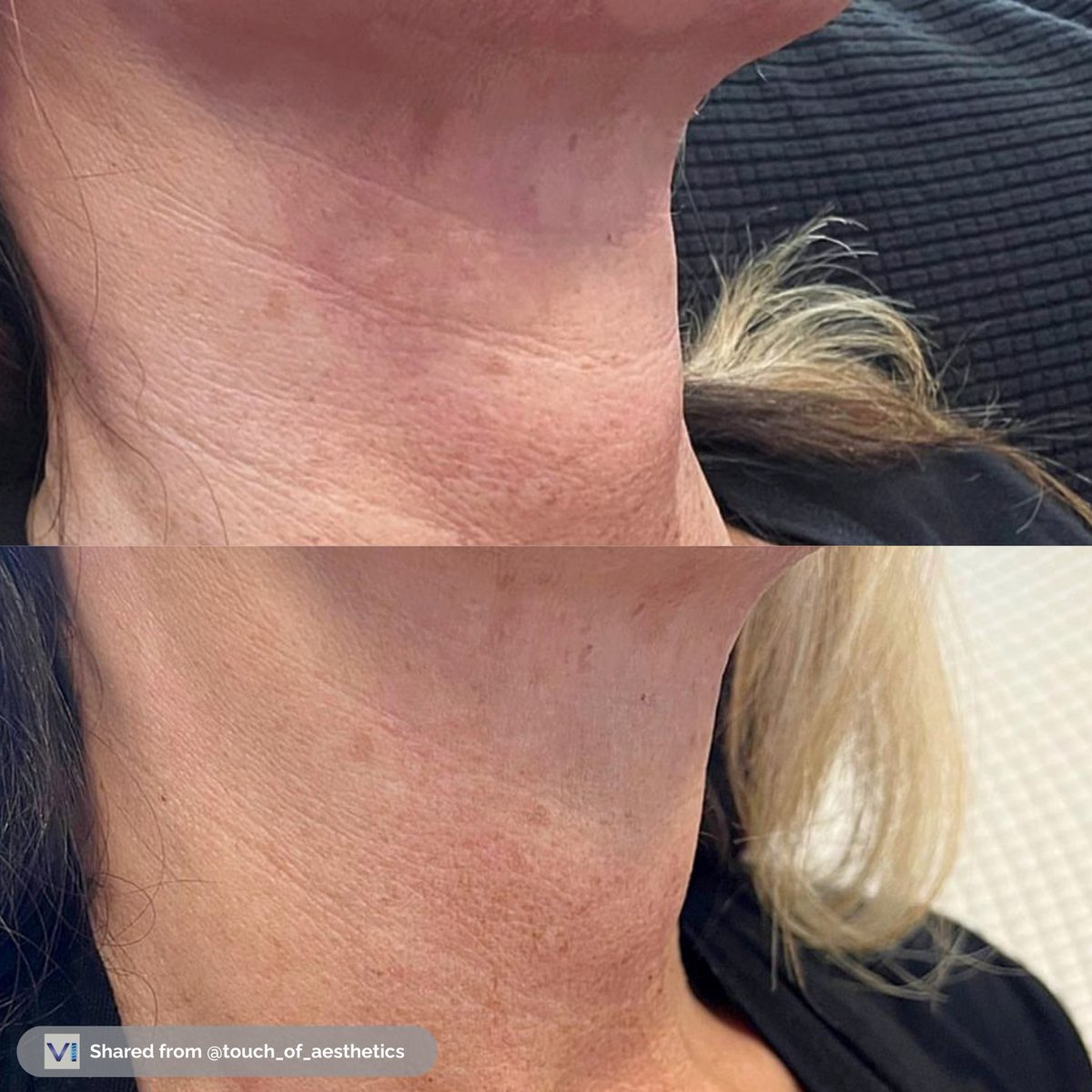 ViolaThreads's tweet image. The transformation has just begun and the results are already huge! These before &amp;amp; after results were taken a month apart after just a single treatment was performed.

Originally posted by Touch of Aesthetics: bit.ly/47lxMXw

#pdothreads #smooththreads #wrinklereduction