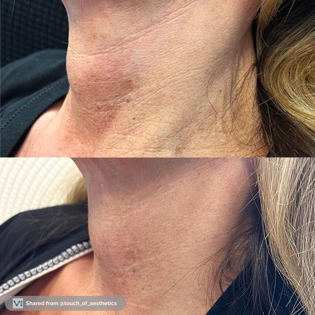 ViolaThreads's tweet image. The transformation has just begun and the results are already huge! These before &amp;amp; after results were taken a month apart after just a single treatment was performed.

Originally posted by Touch of Aesthetics: bit.ly/47lxMXw

#pdothreads #smooththreads #wrinklereduction