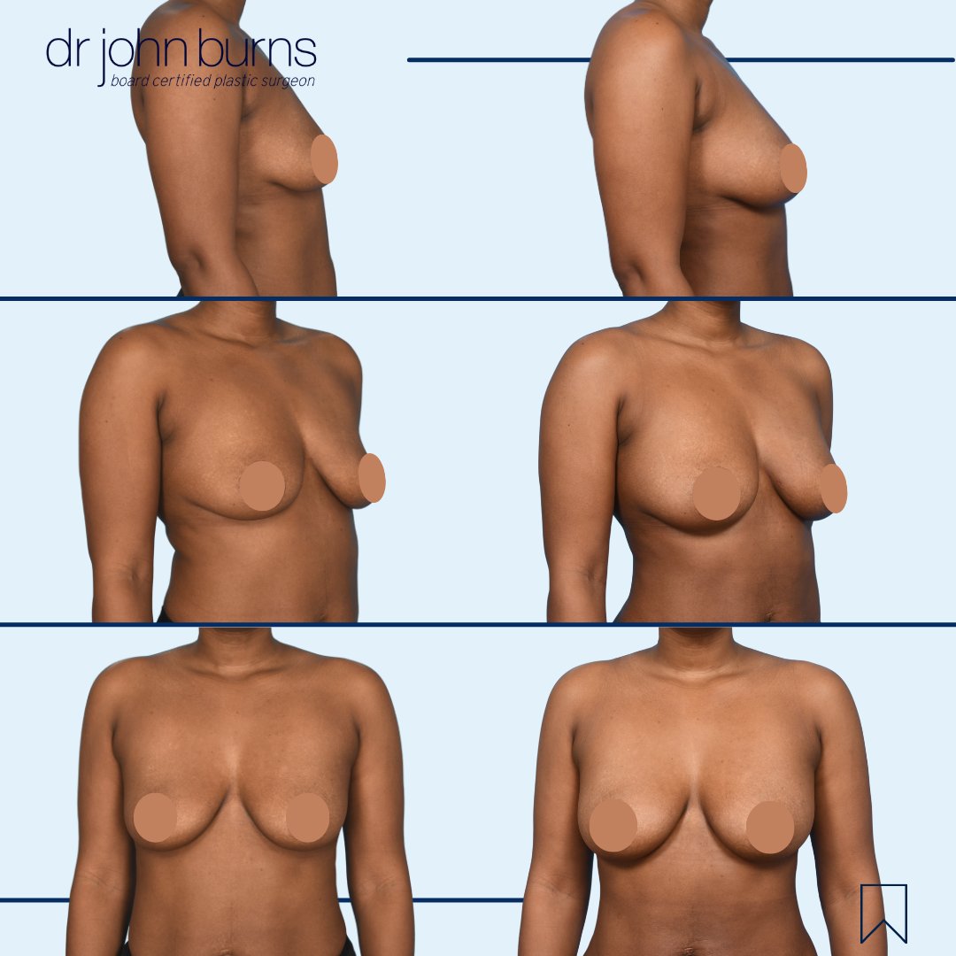 drjohnburns's tweet image. #fattransfer #breastaug. Dr. Burns performed lipo to contour her abs, flanks, and thighs and to repurpose for shaping her breasts. The harvested fat was strategically placed to round and fill her breasts. She got more than a cup size increase and looks terrific!