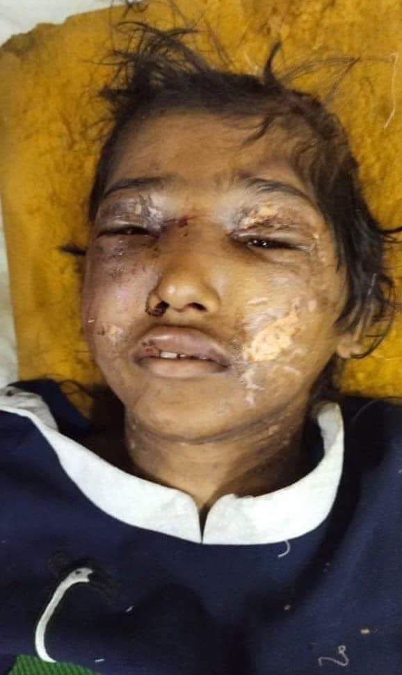 asadmaliklive's tweet photo. اس بچی کے لئے کچھ نہ لکھنا الفاظ کی حرمت کی کمی کے باعث ہوگا۔
اس لاش کو انصاف کو ملنا چاہیے۔
یہ امر بذاتِ خود عزت مآب چیف جسٹس صاحب کے لئے ایک الارمنگ کیس ہے کہ اتنے تسلسل کے ساتھ ججز صاحبان کی بیگمات کے ہاتھوں گھر کی کمسن ملازماؤں پر بےرحمانہ تشدد کے واقعات کیوں ہورہے ہیں؟
یا پھر کوئی نفسیاتی عوارض ہیں جن کی شکار یہ خواتین ہیں۔
آخر ایسا کیا کر دیا ہو گا اس چھوٹی سی بچی نے جس کی بنا پر ایک عورت اس کے ساتھ یہ سلوک کرنے پر آمادہ ہو گئی ؟
