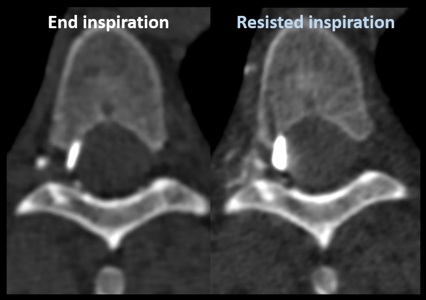brainscandan's tweet image. That’s a great demonstration! I’ve also found resisted inspiration really helpful. The 1st CTM, in end inspiratory breath hold was negative. I later repeated the CTM during resisted inspiration &amp;amp; this CVF filled really well #SIH #spinalCSFleak