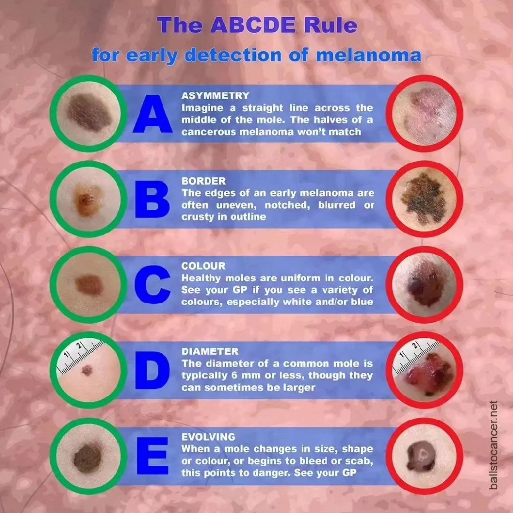 Ballstocancer's tweet photo. It's a #SkinCancer Saturday. Some people don't understand why we ask you to check your skin and why we ask you to cover up in the sun and avoid sunbeds. We do it because skin cancer is rising up that list of cancers as most common killers https://t.co/K5yJQUB4H1 please share https://t.co/56FFiFnfw4
