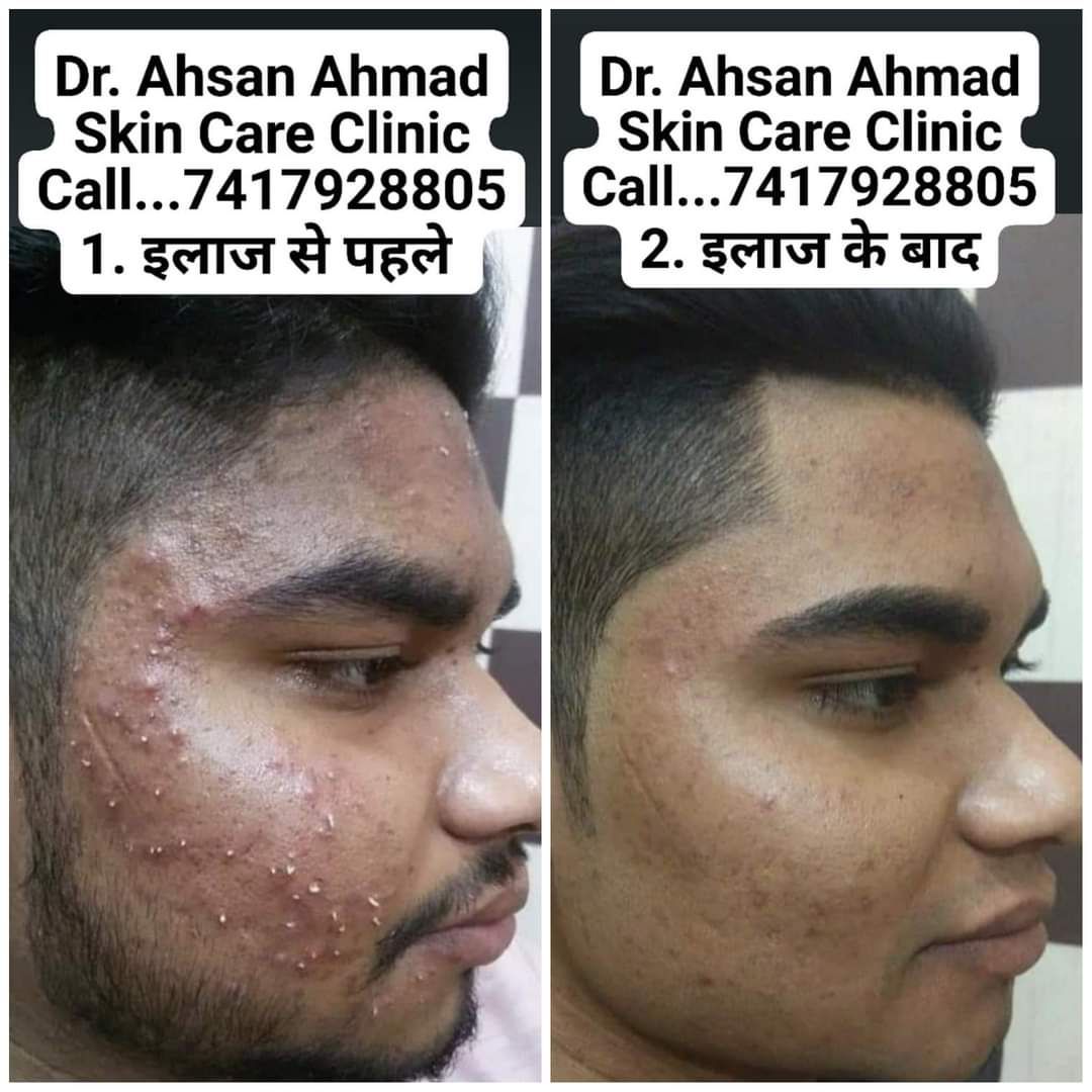AhmadClinic's tweet photo. अहमद स्किन केयर क्लीनिक
डॉ. अहसान अहमद
चर्म रोग विशेषज्ञ (Dermatologist)
BUMS (Kanpur)
MD (Dermatology)
अब स्किन की सभी बीमारियों का सफ़ल इलाज
https://t.co/2jrKt0k0ui
Online Medicine By Courier
Subscribe...
My YouTube channel...
https://t.co/m2jKhReGig https://t.co/4jnemeuTTv
