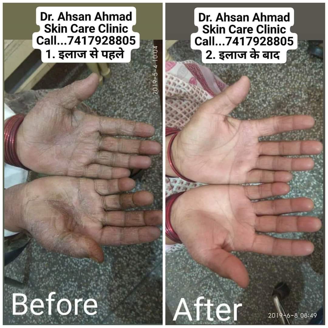 AhmadClinic's tweet photo. अहमद स्किन केयर क्लीनिक
डॉ. अहसान अहमद
चर्म रोग विशेषज्ञ (Dermatologist)
BUMS (Kanpur)
MD (Dermatology)
अब स्किन की सभी बीमारियों का सफ़ल इलाज
https://t.co/2jrKt0k0ui
Online Medicine By Courier
Subscribe...
My YouTube channel...
https://t.co/m2jKhReGig https://t.co/xSPZodR8KW