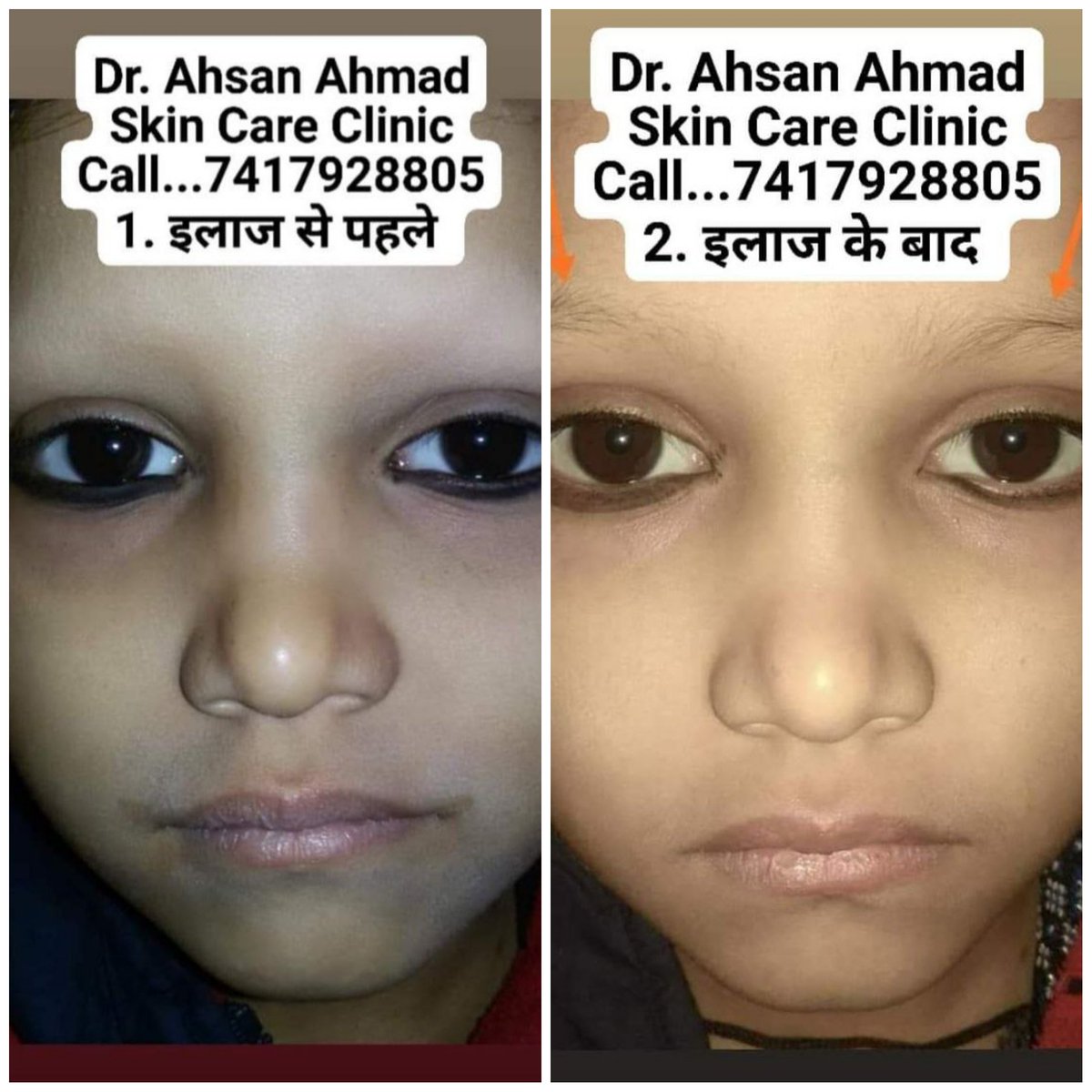AhmadClinic's tweet photo. अहमद स्किन केयर क्लीनिक
डॉ. अहसान अहमद
चर्म रोग विशेषज्ञ (Dermatologist)
BUMS (Kanpur)
MD (Dermatology)
अब स्किन की सभी बीमारियों का सफ़ल इलाज
https://t.co/2jrKt0k0ui
Online Medicine By Courier
Subscribe...
My YouTube channel...
https://t.co/m2jKhReGig https://t.co/bMKZXVUdjD