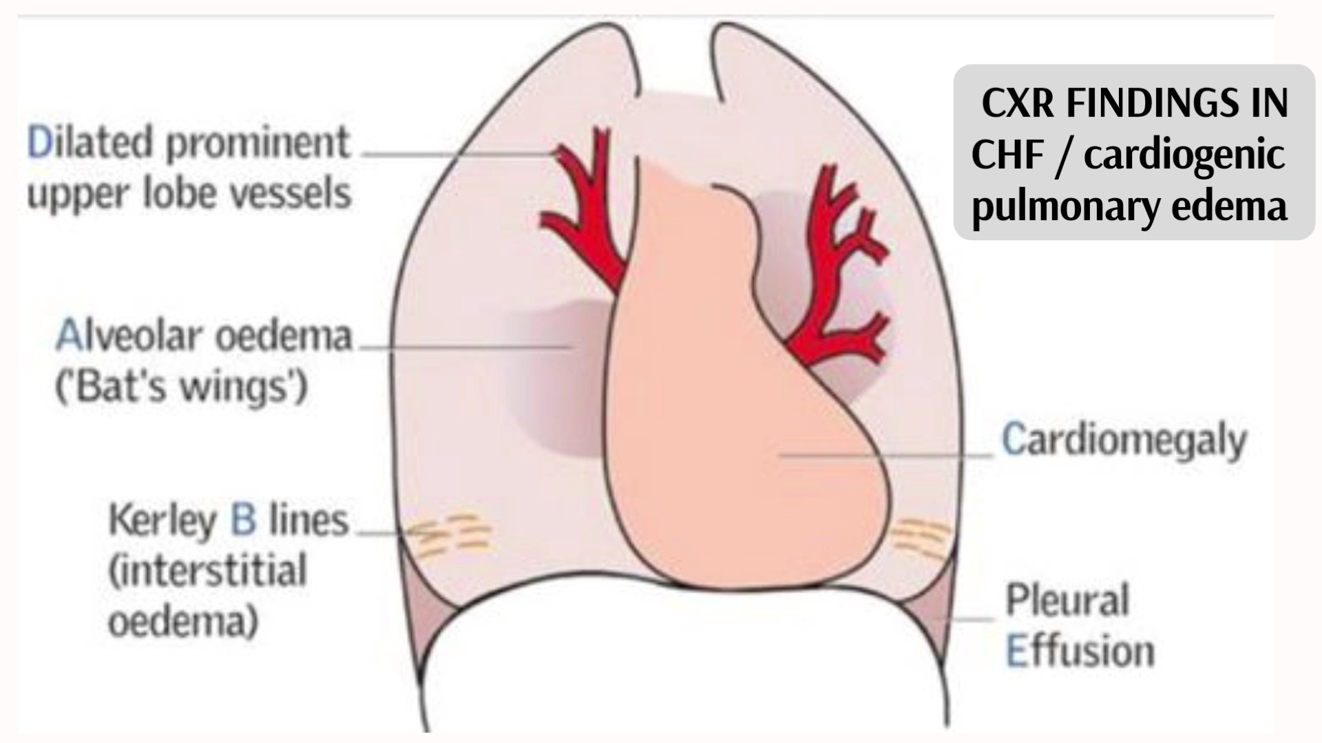Heart Expanded Cardiomegaly Diagram
