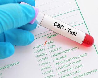 Alahdal_PhD's tweet photo. 📍غردت سابقاً عن إختبار قياس التدفق الخلوي (Flow Cytometry) كواحد من الاختبارات التي تستخدم في مختبر علم أمراض الدم 🩸، واستكمالاً للاختبارات فهناك اختبار أساسي ومهم جداً يتميز به هذا المختبر وهو إختبار تعداد الدم الكامل (Complete Blood Count or CBC) فما هو وما هي أهميته؟ 

- تعداد الدم الكامل (CBC) هو اختبار دم، ويستخدم لتقيم الصحة العامة للمريض وتشخيص حالته سواء كانت فقر الدم أو عدوى أو سرطان دم.

- ما هو الأنبوب المستخدم غالباً لجمع الدم من أجل اختبار تعداد الدم الكامل (CBC)؟ هو أنبوب أرجواني يحتوي على مضاد للتخثر EDTA.

- يقيس اختبار تعداد الدم الكامل ما يلي:
(1) خلايا الدم الحمراء التي تحمل الأكسجين.
(2) خلايا الدم البيضاء التي تحارب العدوى.
(3) الهيموجلوبين وهو البروتين الحامل للأكسجين في خلايا الدم الحمراء.
(4) الهيماتوكريت (HCT) ويعبر عن كمية خلايا الدم الحمراء في الدم.
(5) الصفائح الدموية التي تساعد الدم على التجلط.

- يمكن أن يظهر تعداد الدم الكامل زيادات أو انخفاضات غير عادية في عدد الخلايا، وقد تشير هذه التغييرات إلى حالة طبية تتطلب المزيد من الاختبارات، ويتم اجراء هذا الاختبار لأسباب عديدة منها:
(1) للنظر في الصحة العامة حيث يعتبر الاختبار جزئاً من الفحص الطبي للتحقق من الصحة العامة والبحث عن حالات مثل فقر الدم أو سرطان الدم كما ذكرت سابقاً.
(2) لتشخيص حالة طبية حيث يساعد في العثور على سبب بعض الأعراض مثل الضعف والتعب والحمى، ويساعد أيضاً في العثور على سبب التورم والألم أو الكدمات أو النزيف
(3) للتحقق من حالة طبية حيث يساعد في مراقبة الحالات التي تؤثر على تعداد خلايا الدم
(4) للتحقق من العلاج الطبي من خلال مراقبة العلاج بالأدوية التي تؤثر على تعداد خلايا الدم والإشعاع.

- ختاماً قد تشير النتائج الغير طبيعية (سواء كانت مرتفعة أو منخفضة) من وجود خلل أو مشكلة ما فكل معامل يرتبط بحالة ما وهنا امثلة على ذلك:
(1) عدد خلايا الدم الحمراء والهيموجلوبين والهيماتوكريت: ترتبط نتائج هذه الثلاثة لأنها تقيس كل منها سمة من سمات خلايا الدم الحمراء. 
* فإذا كانت أقل من الطبيعي فهي علامة على فقر الدم، وفقر الدم له العديد من الأسباب، وهي تشمل مستويات منخفضة من بعض الفيتامينات أو الحديد أو فقدان الدم أو أي حالة طبية أخرى، وغالباً يشعر الأشخاص المصابون بفقر الدم بالضعف أو التعب. * إما إذا كانت عدد خلايا الدم الحمراء أعلى من الطبيعي بمعنى كثرة الكريات الحمراء أو ارتفاع مستويات الهيموجلوبين أو الهيماتوكريت فهذا يشير إلى حالة طبية مثل سرطان الدم أو أمراض القلب أو غيره من الحالات الطبية. 

(2) عدد خلايا الدم البيضاء: 
 * حالة انخفاض عدد الخلايا البيضاء قد يرتبط بحالات طبي مثل اضطراب المناعة الذاتية الذي يدمر خلايا الدم البيضاء أو مشاكل نخاع العظام أو السرطان، ويمكن لبعض الأدوية أيضا أن تسبب انخفاضا في عدد خلايا الدم البيضاء.  * أما ارتفاع عدد خلايا الدم البيضاء يكون أكثر شيوعا في حالات العدوى أو الالتهاب، أو يمكن أن يشير إلى اضطراب في الجهاز المناعي أو مرض نخاع العظم، ويمكن أن يكون ارتفاع عدد خلايا الدم البيضاء أيضا ردة فعل من بعض الأدوية أو التمارين الرياضية الشاقة.

(3) عدد الصفائح الدموية: 
* إذ كان عدد الصفائح أعلى من الطبيعي، فممكن أن يكون إما علامة على حالة طبية أو تأثير جانبي من دواء معين، ومن المرجح أن يؤدي عدد الصفائح الدموية الغير طبيعي إلى المزيد من الاختبارات لتشخيص السبب.