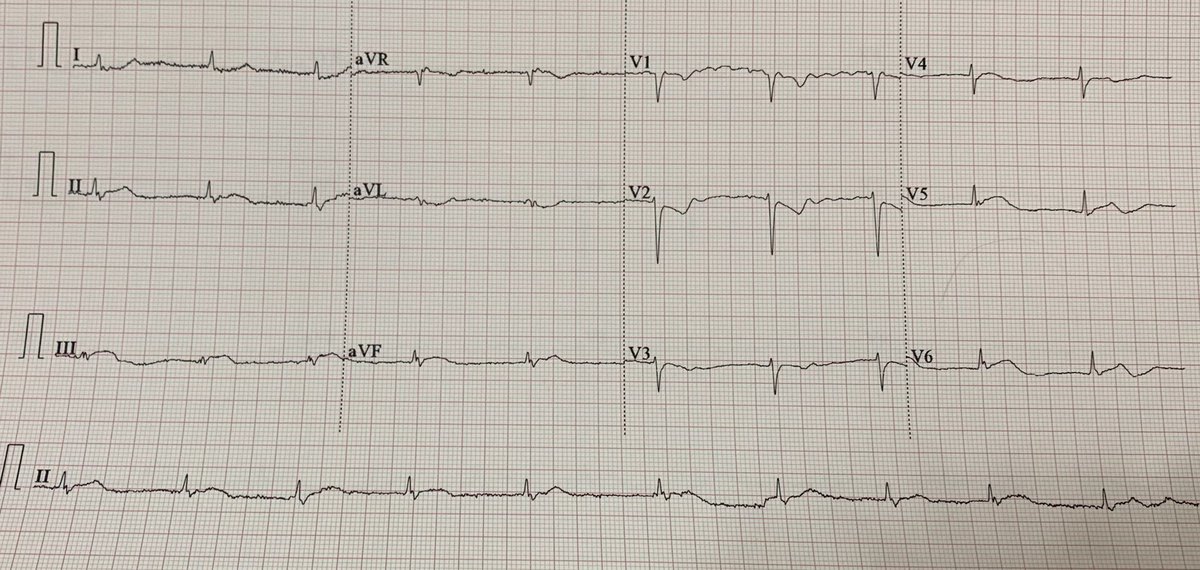 EcgsOnly's tweet photo. Chest pain

DX ? https://t.co/RouRBwg16b