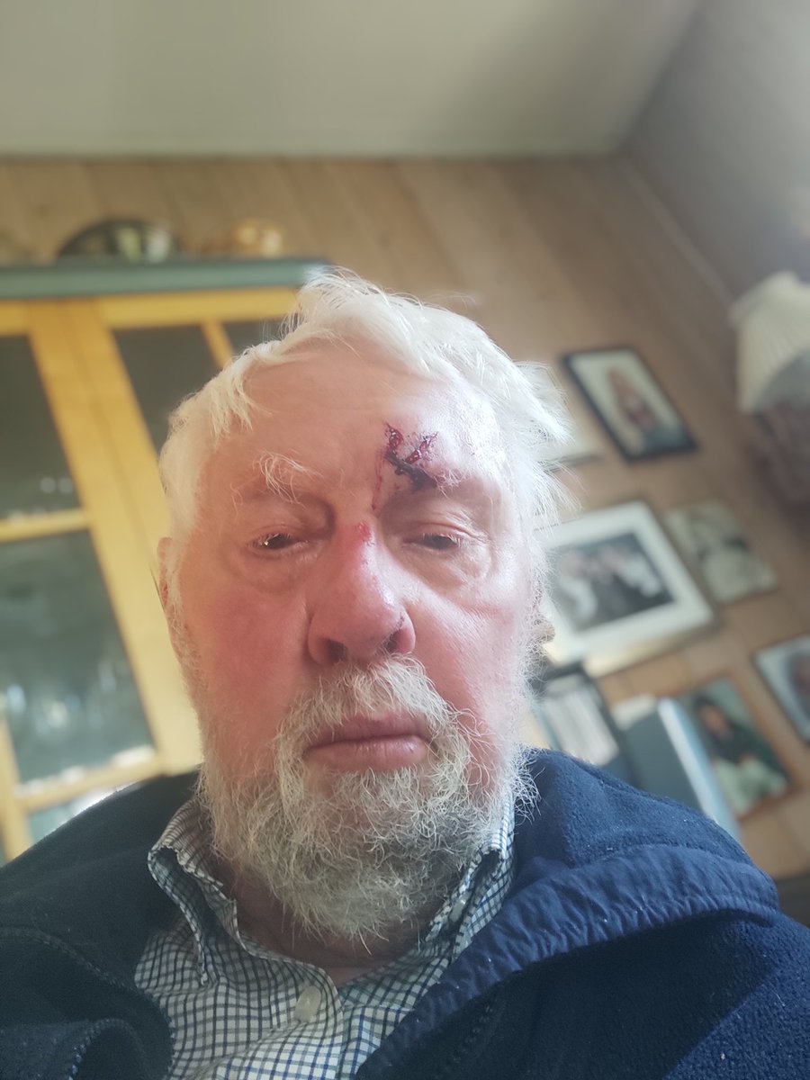 Fredagselfie stelt fint av vår sønn legen, med steri-strips. Sabla fortauet som kom opp og dro til meg. Nå lager vi handleliste til ODA som kan levere i morgen.