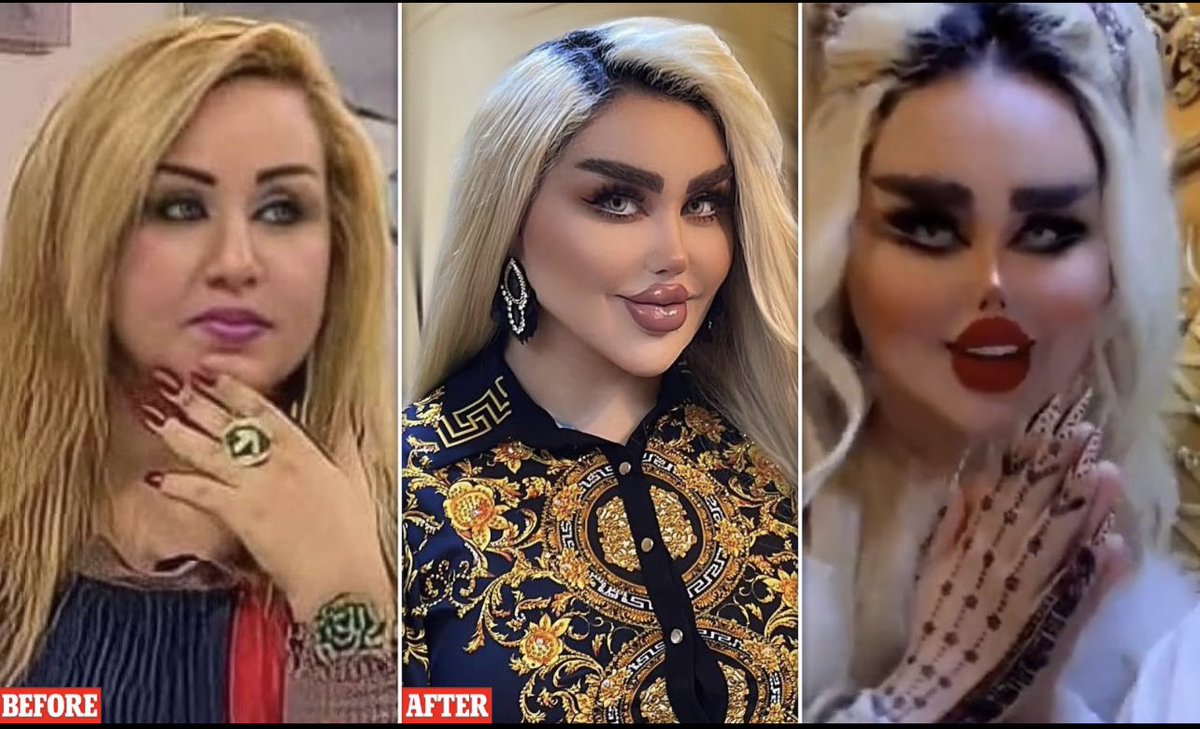 Baghdad-born Dalia Naeem has reportedly undergone 43 cosmetic procedures #dontdobarbie