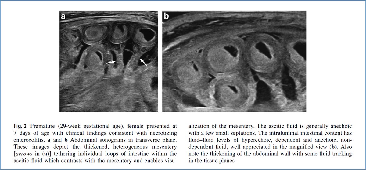 Recent publication from our former fellow Dr Catalina Le Cacheux (now at <a href="/ChildrensPgh/">UPMC Children's Hospital of Pittsburgh</a> ) with our faculty Drs Alan Daneman &amp; Ricardo Faingold titled: Association of new sonographic features with outcome in neonates with #NEC in <a href="/PedRadJournal/">Pediatric Radiology</a> doi: 10.1007/s00247-023-05641-6