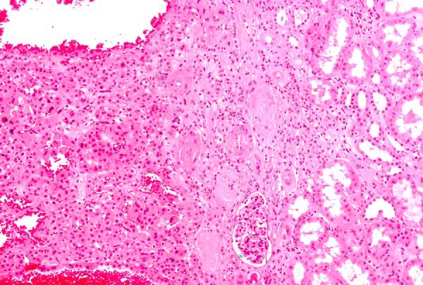 Path4People's tweet photo. Eosin's stain, a shade of pink,
Unveils the secrets that pathologists think,
Cancer's hue, akin to Barbie's dye,
Pathology uncovers truths that lie.
#abcsofpathology
#pathtwitter
#eosin
#medstudenttwitter #medtwitter #histology https://t.co/f5Kq6XWGdu