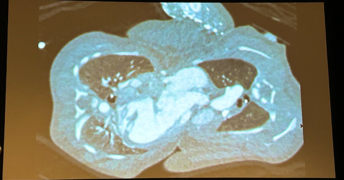 Daniel Lorenzatti, MD. (@danilorenzatti) on Twitter photo It can't get more complex than this!
Marvelous session on CHD. #YesCCT #SCCT2023 🎩👏<a href="/Heart_SCCT/">Heart_SCCT</a> It can't get more complex than this!
Marvelous session on CHD. #YesCCT #SCCT2023 🎩👏<a href="/Heart_SCCT/">Heart_SCCT</a>