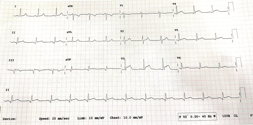 Fenerist63's tweet photo. A 45 y/o male has been feeling on/off central chest pain since yesterday. @FloydECGs @smithECGBlog @PendellM @The_Nanashi_O @RobertHermanMD #ECG https://t.co/huLkhIx45D