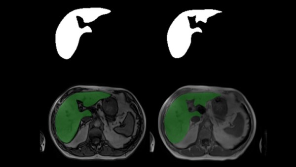 @DukeRadiology Liver MRI Dataset: train series classification models or liver segmentation models buff.ly/3OutLsm @MazurowskiPhD @walterfwiggins @DukeMedSchool #LiverDisease #ML #MachineLearning