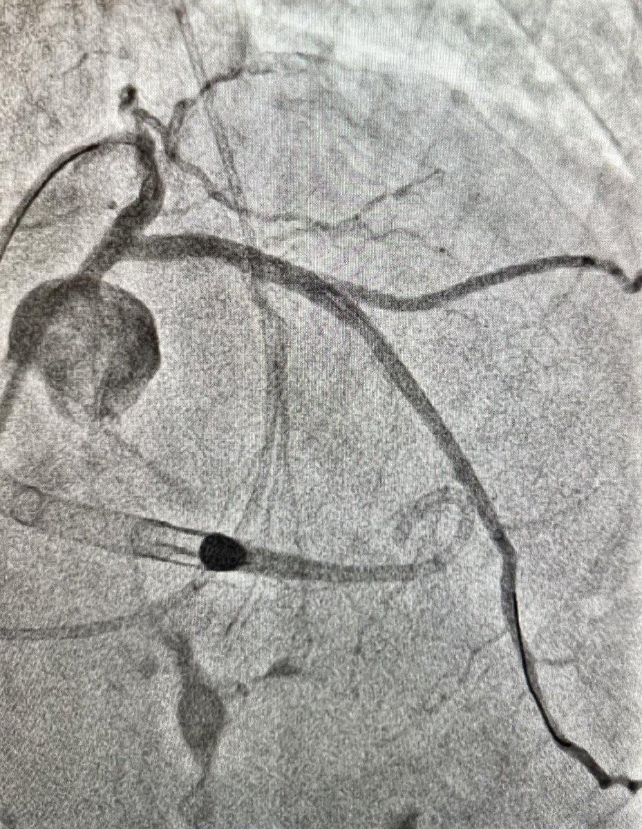 Jon George (@jcgeorgemd) on Twitter photo #CTOPCI at #PennsyInterventions: Successful PCI of distal LM and ostial LCX CTO with Impella pLVAD support in patient with ischemic cardiomyopathy.
<a href="/PennCardiology/">Penn Cardiology</a> <a href="/PennCVFellows/">Penn Cardiology Fellows</a> <a href="/GPAngioClub/">Phila Angio Club</a> <a href="/ReVascMed/">ReVascMed</a> #CTOPCI at #PennsyInterventions: Successful PCI of distal LM and ostial LCX CTO with Impella pLVAD support in patient with ischemic cardiomyopathy.
<a href="/PennCardiology/">Penn Cardiology</a> <a href="/PennCVFellows/">Penn Cardiology Fellows</a> <a href="/GPAngioClub/">Phila Angio Club</a> <a href="/ReVascMed/">ReVascMed</a>